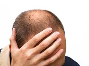 CADUTA DEI CAPELLI